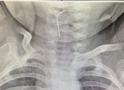 "Өңешінде тұрып қалған": түркістандық дәрігерлер ине жұтып қойған сәбиді құтқарып қалды (фото)